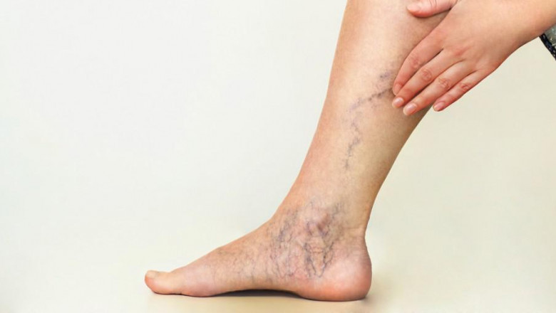 HOW TO STOP AND TREAT VEIN DISEASE?