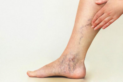 Spider Veins Clinic Near Me
