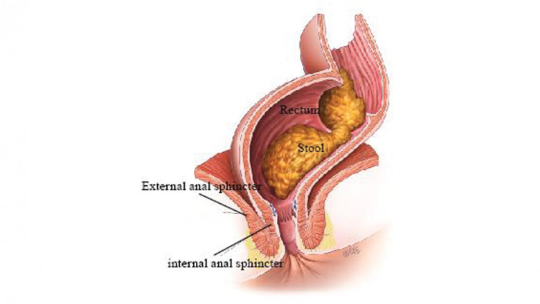 Fecal Incontinence Market Will Reflect the Noticeable CAGR by the End of Forecast Period 2027