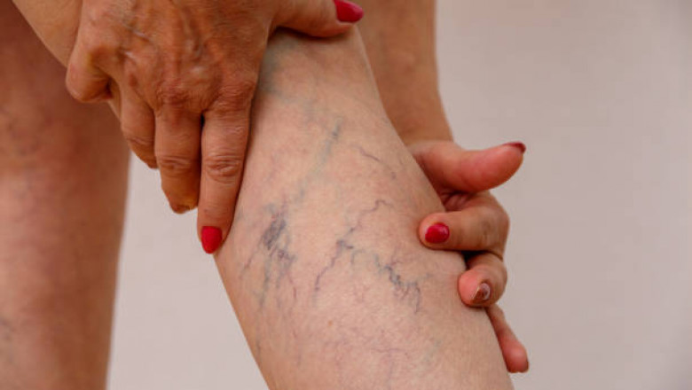How Successful is Your Varicose Vein Treatment?