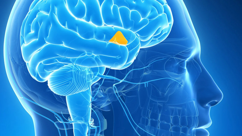 Radiation therapy or tumor removal are typically used in Acromegaly Treatment to reduce growth hormone production by pituitary glands