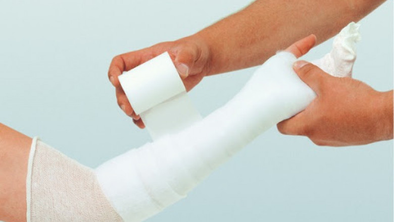 The purpose of casting and splinting products is to join bones, join limbs, and treat fractures