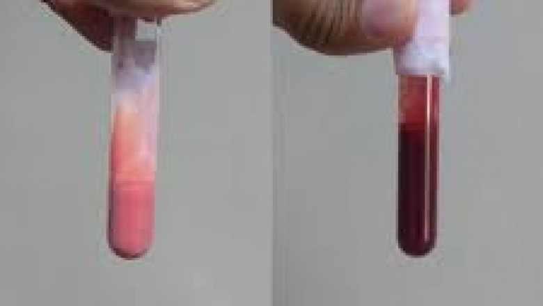 There's no FDA-approved Familial Chylomicronemia Syndrome Treatment
