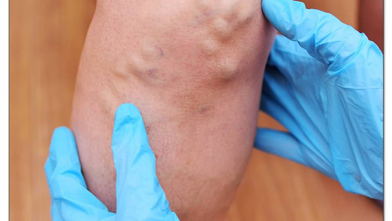 AYURVEDIC TREATMENT FOR DEEP VEIN THROMBOSIS (DVT)