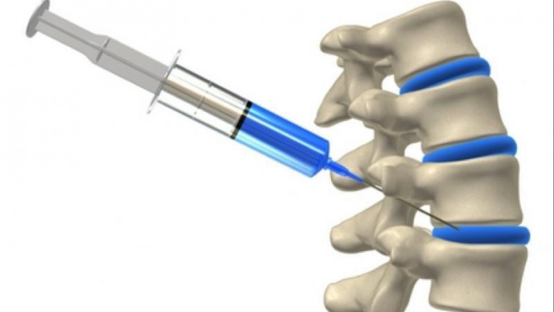 Fixation of joint implants to the bone using antibiotic bone cement and casting materials