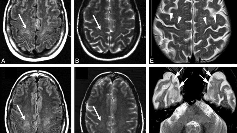 Amyotrophic Lateral Sclerosis Market MRFR Reveals Covid-19 Analysis for 2021-2027