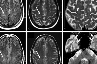 Amyotrophic Lateral Sclerosis Market MRFR Reveals Covid-19 Analysis for 2021-2027