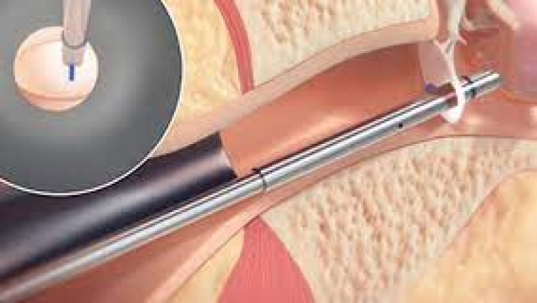 One of the devices on the rise in the Tympanostomy Products Market is the eon Medtech palm