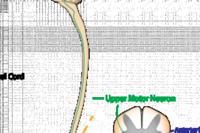 Amyotrophic Lateral Sclerosis Market Revenue Analysis, Business Insights, Developments and Opportunity Assessment by 2027