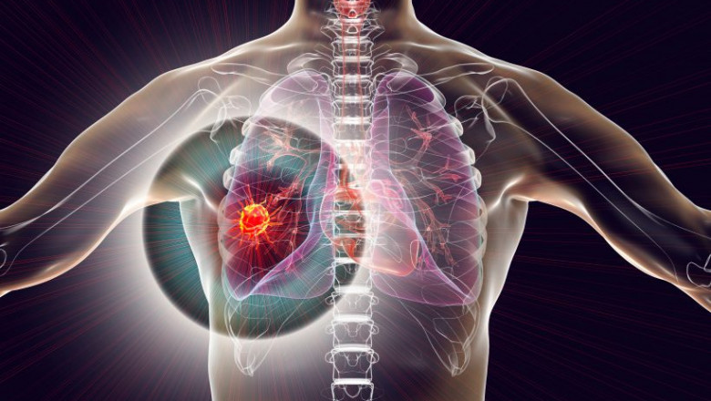 Non Small-Cell Lung Cancer Market To Gain Substantial Traction Through 2030
