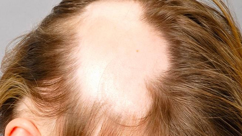 The most common therapies available for the Androgenetic Alopecia Treatment are minoxidil and 5-alpha reductase inhibitors