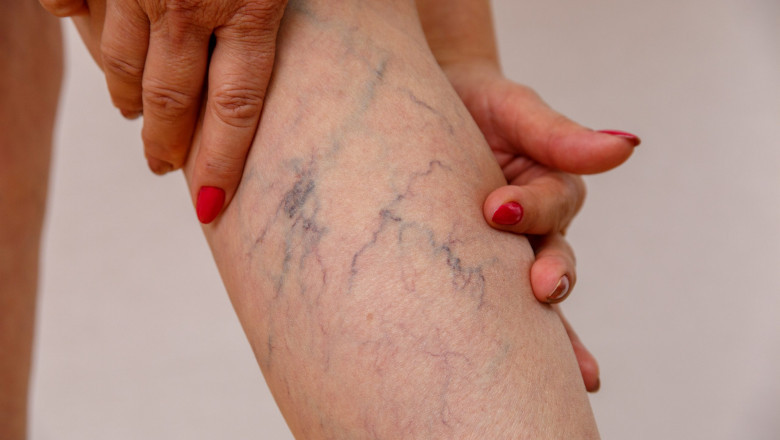 Varicose Vein Center Near Me
