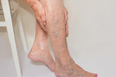 Lindenhurst Vein Treatment Near Me