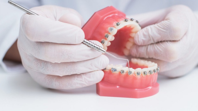 What Precautions You Should Take After Dental Filling?