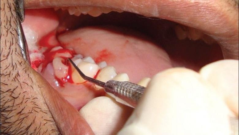 Nine Home remedies for tooth abscess: