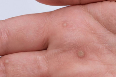 Acute Bacterial Skin and Skin Structure Infections (ABSSSI) are bacterial infections that cause a large abnormal patch of tissue to develop around wounds