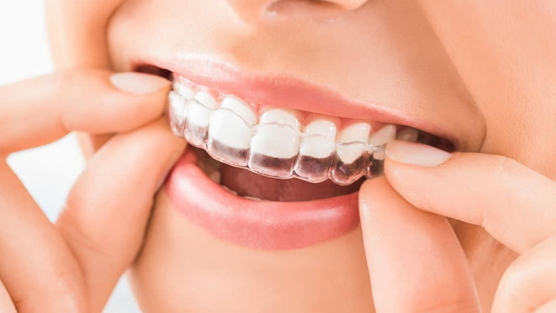 How Much Is the Invisalign Cost?