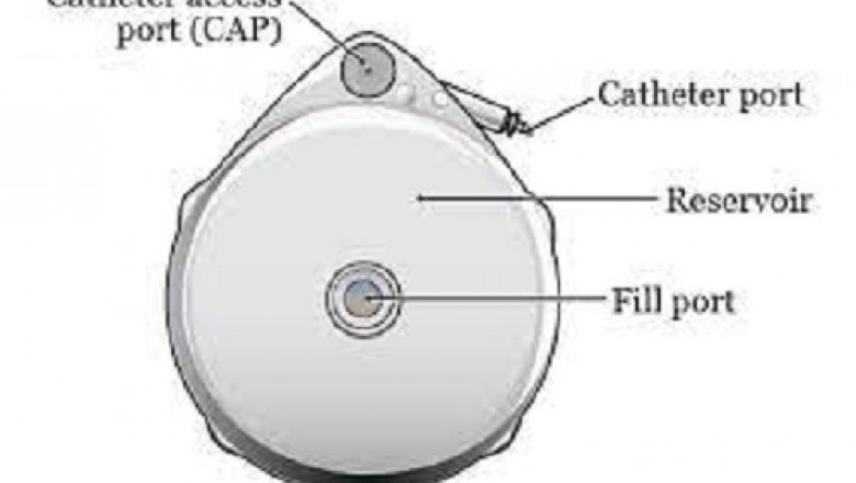 Implantable Infusion Pumps Market Overview, Analysis forecast to 2028