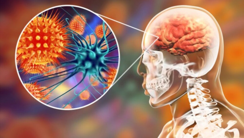 Meningitis Symptoms - Top Five Symptoms of Meningitis