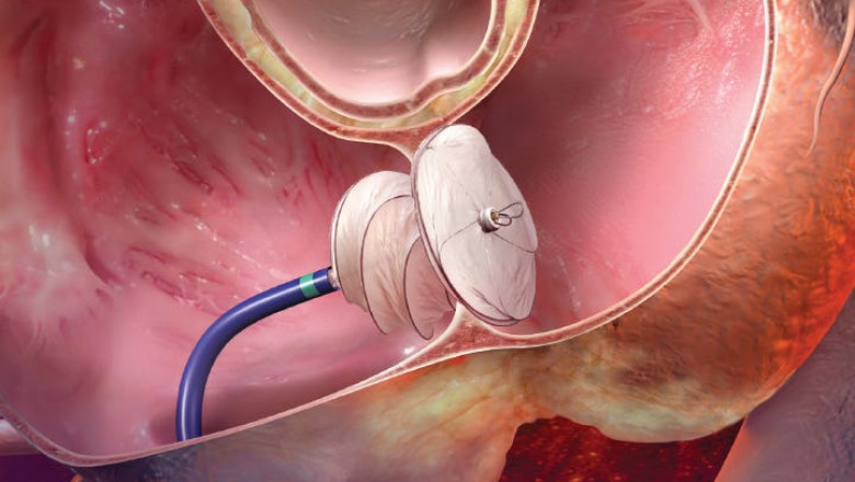 Patent Foramen Ovale (PFO) Closure Devices remain permanently in the heart to stop the abnormal flow of blood between the heart's two atrial chambers