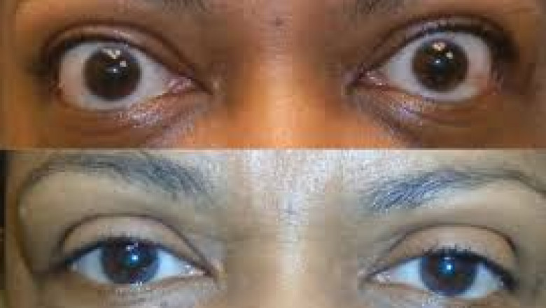 Thyroid eye disease treatment is divided into two stages
