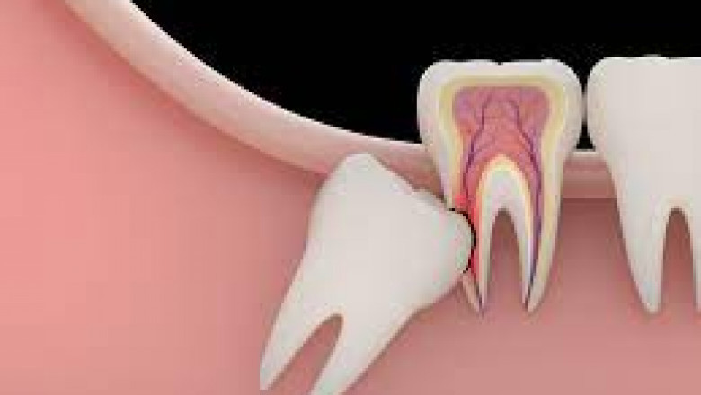 What are the Reasons and Procedures for Wisdom Tooth Extraction?