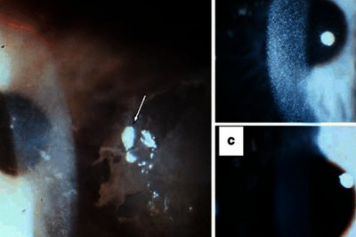 Cystinosis treatment varies dependent on the patient's age, type, and severity of the disease.