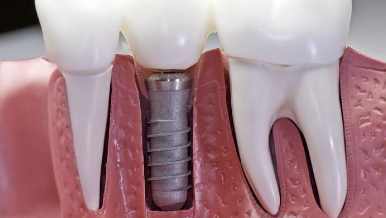 Intramucosal Implants Effects and Techniques