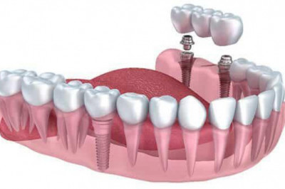 Intramucosal Implants have a more profound effect on the bone than dentures since they integrate the bone directly into the jawbone
