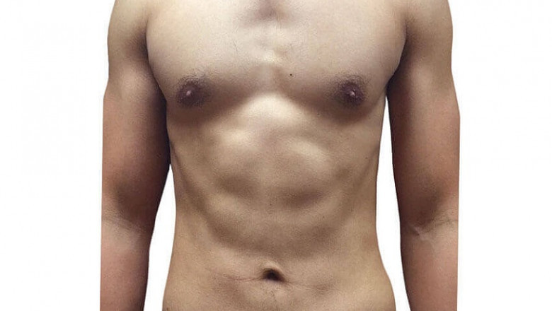 Liposuction vs Tummy Tuck- Which One Do You Choose?