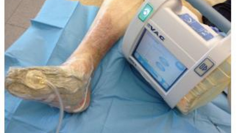 Negative Pressure Wound Therapy Market Share, Industry Leaders, Growing Demand, Opportunities, Competition, Key Players Analysis, 2027