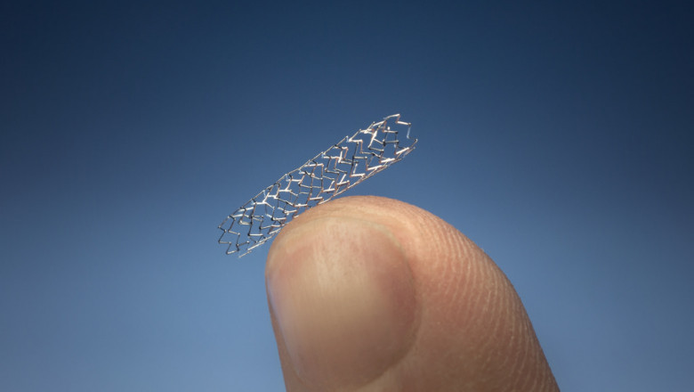 The most commonly used technique for Percutaneous Coronary Intervention (PCI) involves placing a thin stainless steel Coronary Stent