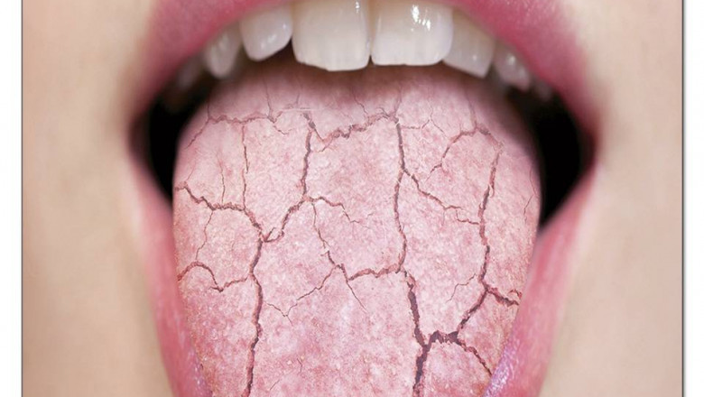 NATURAL TREATMENT OF XEROSTOMIA