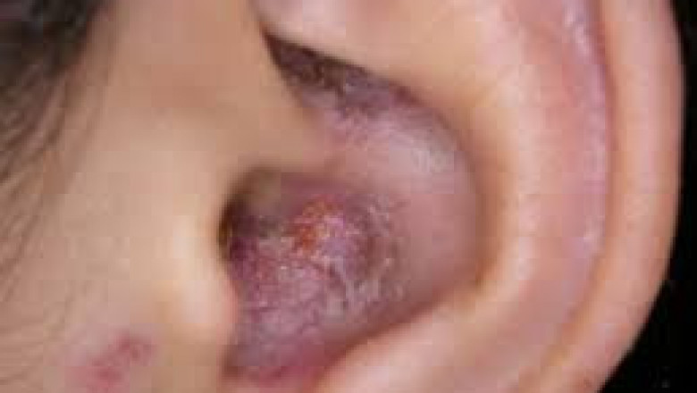 When not recognized and treated promptly, fungal otitis externa can prove fatal