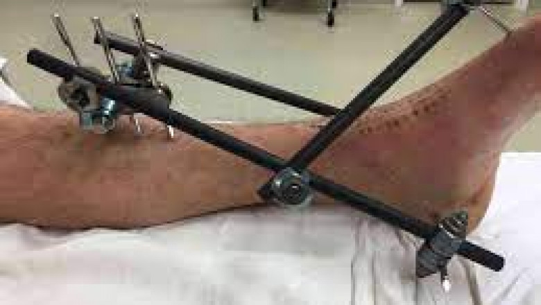 External Fixators are structures that are used to support surgical rods that are screwed into the bones.
