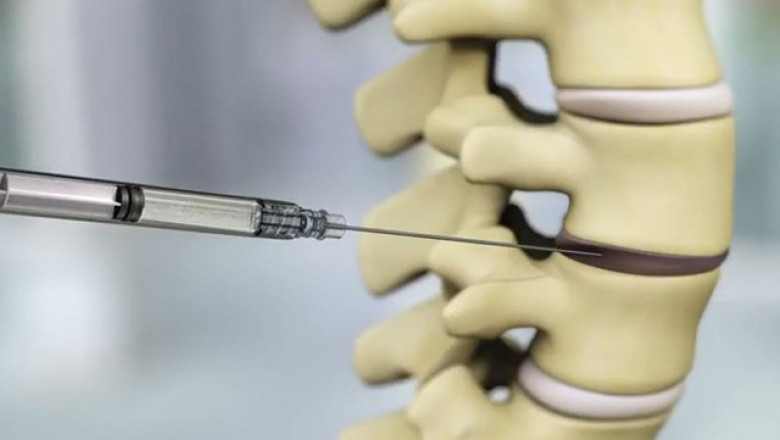 U.S. Degenerative Disc Disease Treatment; helps the body adjust to the damaged disc and manages symptoms.