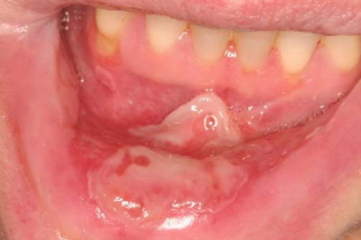 U.S. Severe Oral Mucositis usually affects the mouth and often results from cancer treatments