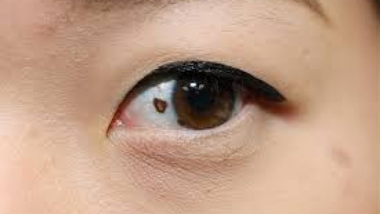 Intraocular Melanoma Treatment Market: Future Innovation Strategies, Growth & Profit Analysis, Forecast By 2026