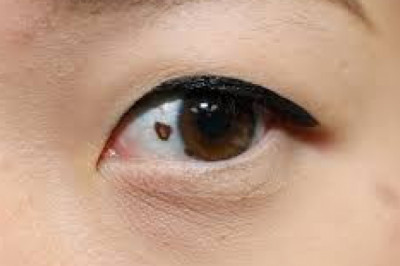 Intraocular Melanoma Treatment Market: Future Innovation Strategies, Growth & Profit Analysis, Forecast By 2026