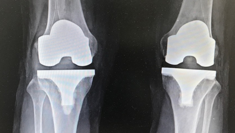 Knee Replacement Surgeon in Patna | Procedure and Cost of Total Knee Replacement