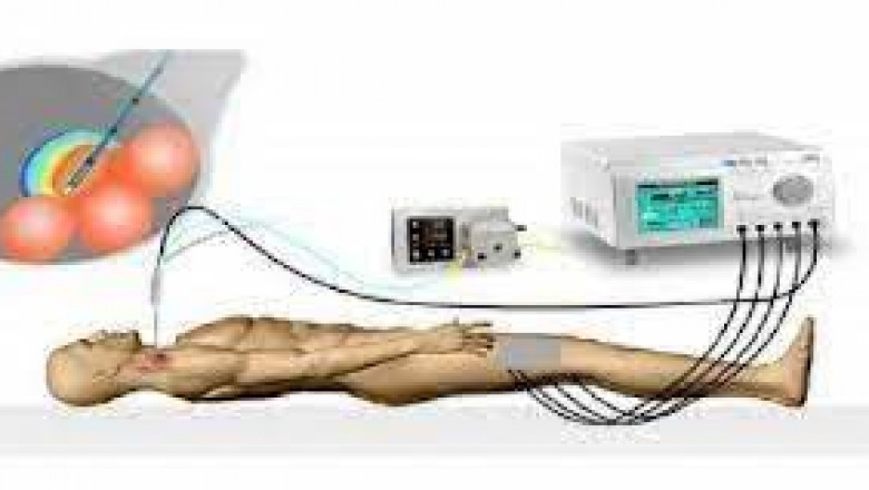 Radio Frequency Ablation Devices are sophisticated medical devices that are used to treat pain in a variety of surgical and non-surgical situations.