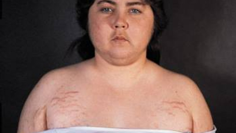 Cushings Syndrome Market Insights, and Forecast
