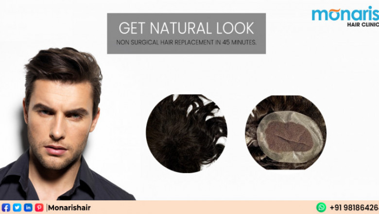 Hair Replacement in Delhi