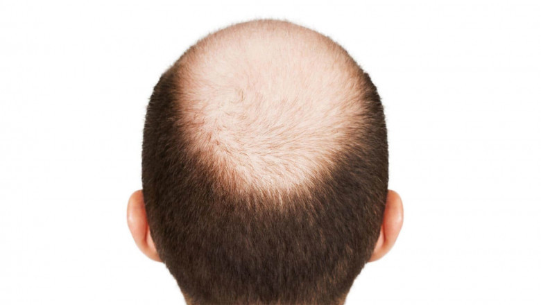 Hair transplantation clinic - Nova Cosmetic | Hair transplant in Coimbatore