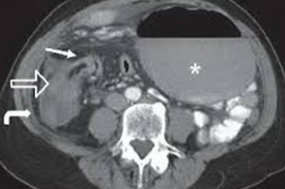 NATURAL TREATMENT FOR CECAL VOLVULUS