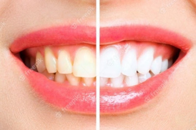 How can I whiten my teeth