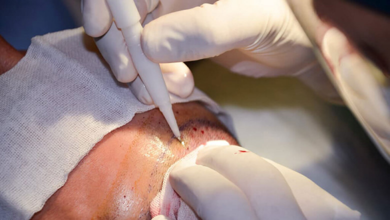 Completely Examine The Hair Transplant Establish you back Formerly You Devote