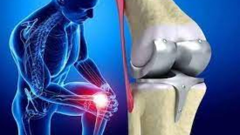Artificial Joints Market: Global Industry Analysis, Trends, Market Size, and Forecast