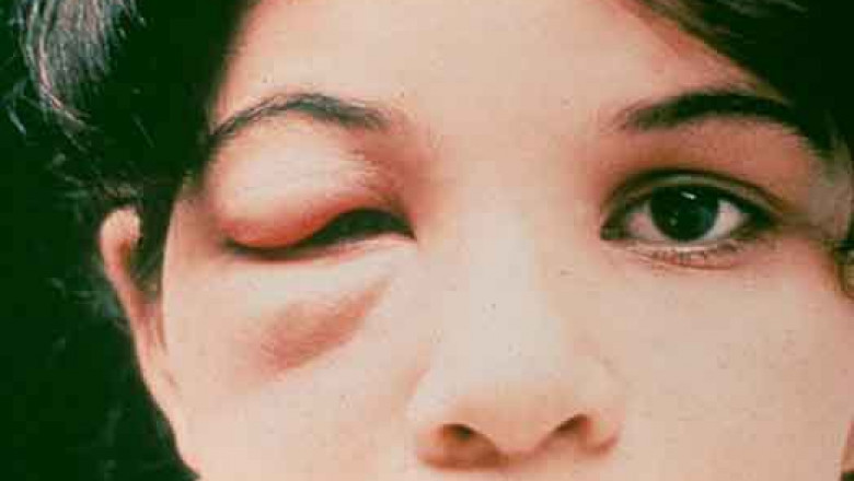Global Chagas Disease Treatment Market- Global Industry Analysis, Size, Share, Growth, Trends, and Forecast