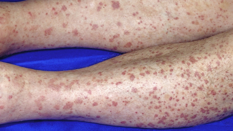 Vasculitis Treatment Market- Global Industry Analysis, Size, Share, Growth, Trends and Forecast